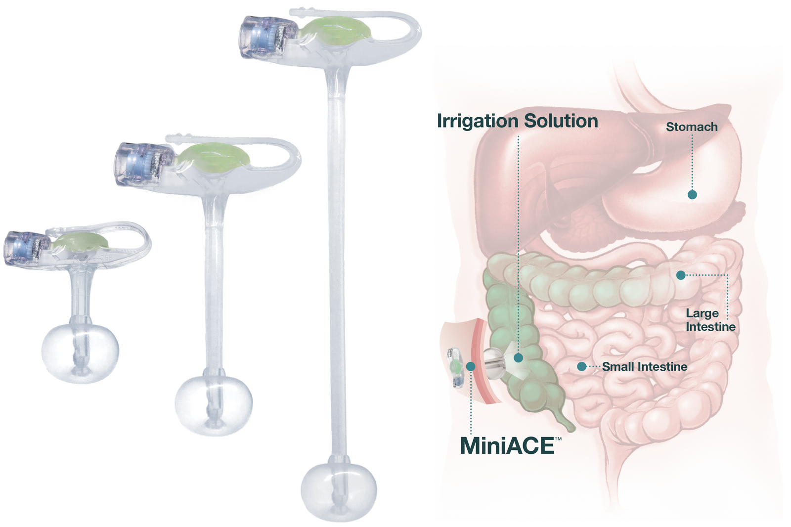 Understanding Bowel Management