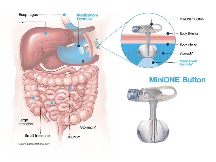Understanding Enteral Feeding