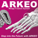 Auxano® Medical Receives FDA 510(k) Clearance for the ARKEO™ Wedge Fixation System
