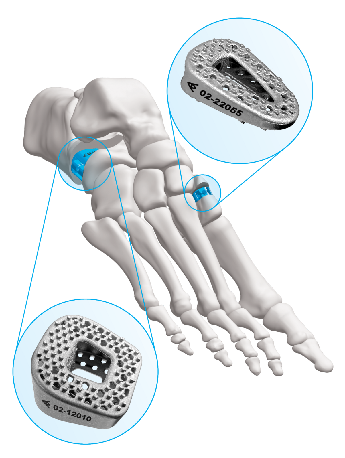Wedge Osteotomy, Reinvented